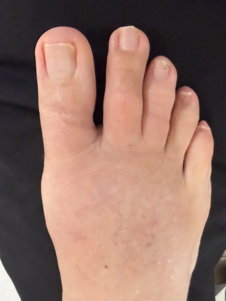 Patient foot after bunion and hammertoe correction