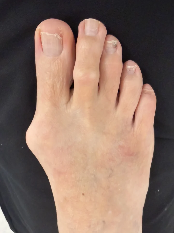 Patient foot before bunion and hammertoe correction