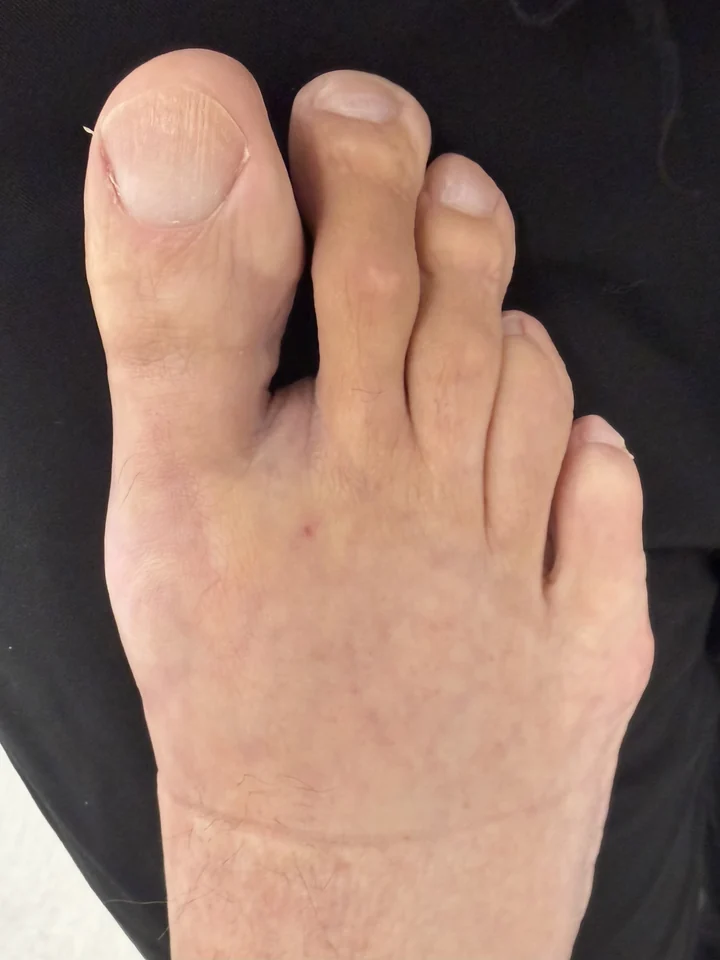 Patient foot after bunion treatment