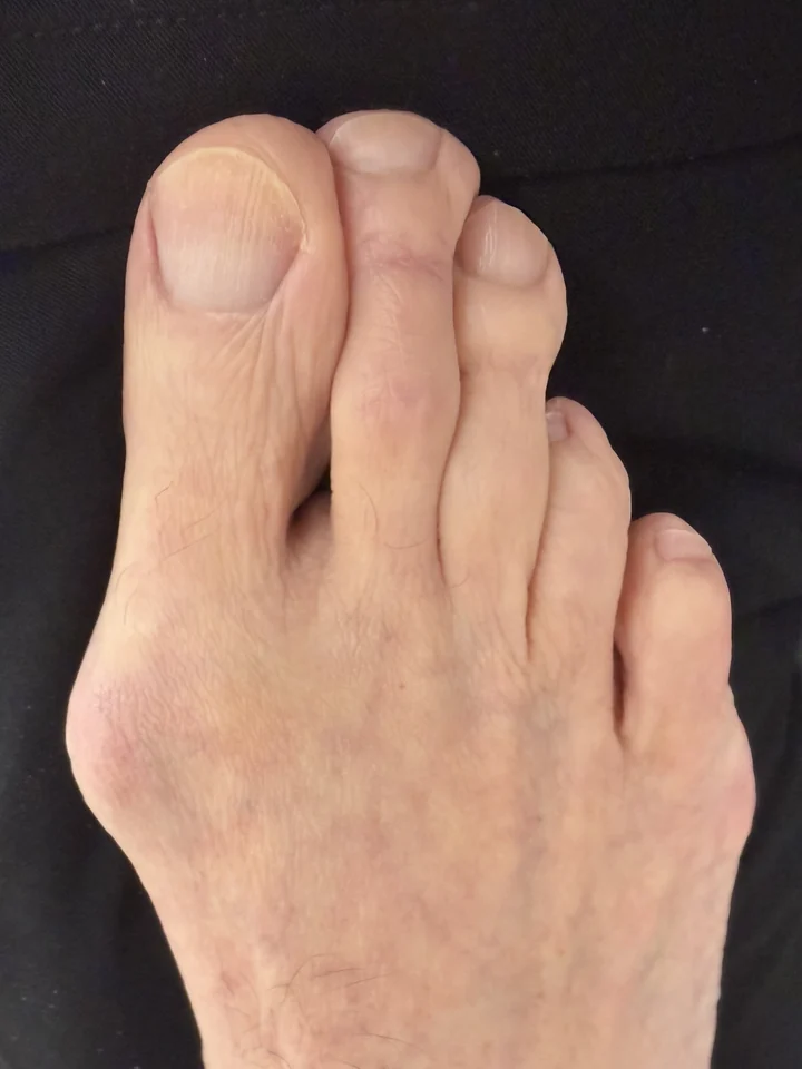 Patient foot before bunion treatment