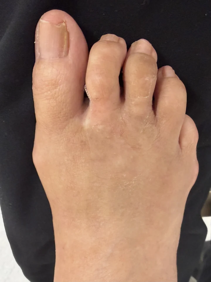 Patient foot after forefoot alignment treatment